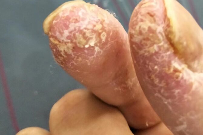 Acrodermatitis continua of Hallopeau (ACH) 连续性肢端皮炎