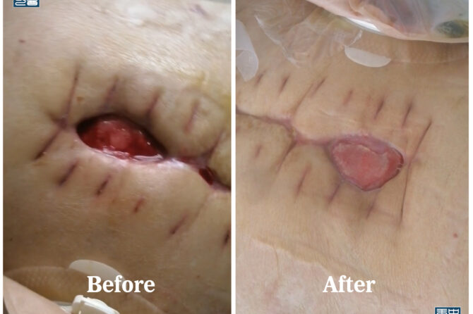 HLQ Herbal Ointment dressing for Open Abdominal Wounds With Intestinal Fistula 中药药膏治疗肠瘘开放性腹部伤口