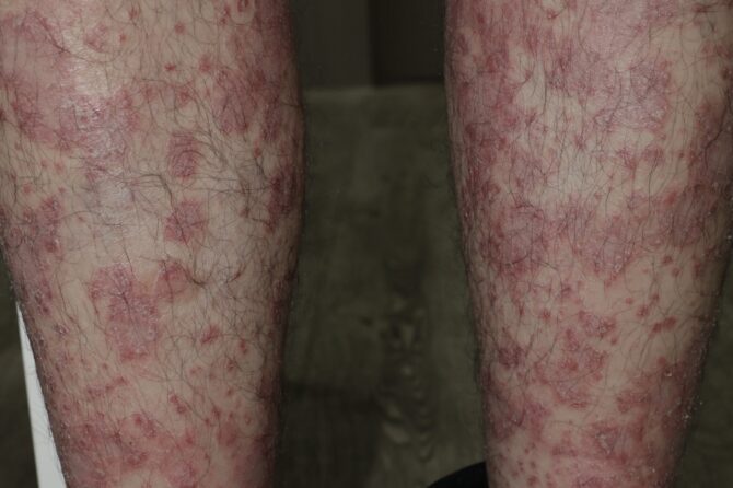 Psoriasis or Pityriasis Rubra Pilaris 是牛皮癣还是毛发红糠疹