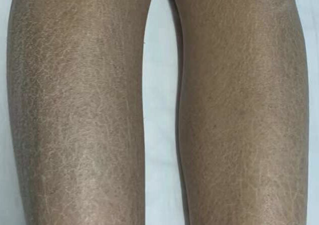 A Case of Ichthyosis vulgaris IV鱼鳞癣