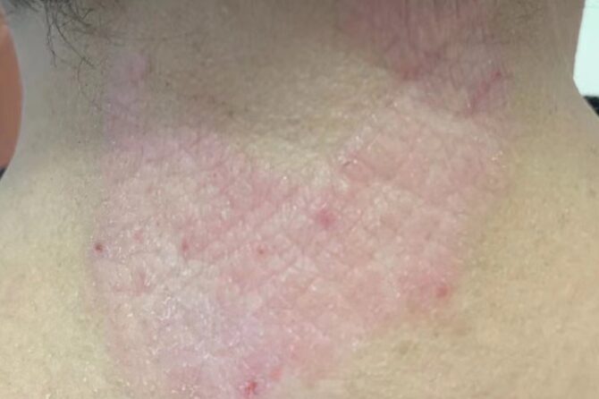 Neurodermatitis (Lichen Simplex Chronicus) 神经性皮炎