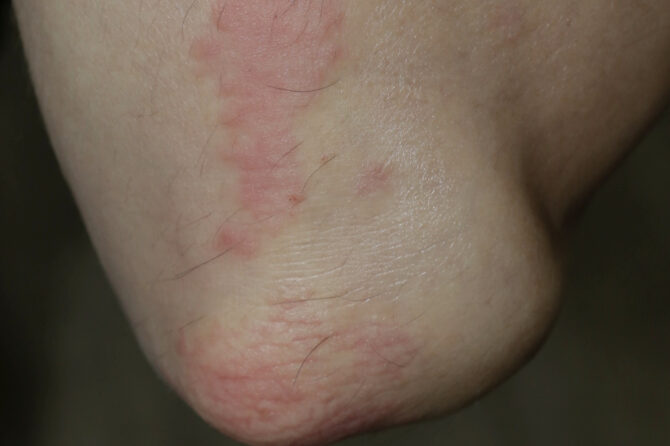 Man with 5 months of Psoriasis Vulgaris 牛皮癣