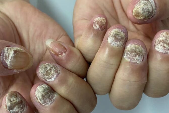 Acrodermatitis Continua of Hallopeau (ACH) or Palmoplantar Pustular Psoriasis (PPP) 连续性肢端皮炎还是掌跖脓疱型银屑病