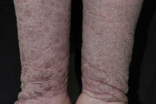 Herbal Medicine for Post-Vaccination Psoriasis Exacerbation: A Case Report and Treatment Outcome 疫苗接种后银屑病加重的中药治疗：病例报告与疗效观察