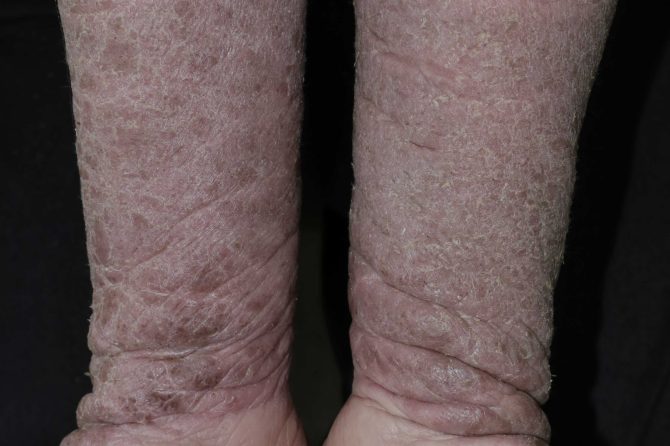 Herbal Medicine for Post-Vaccination Psoriasis Exacerbation: A Case Report and Treatment Outcome 疫苗接种后银屑病加重的中药治疗：病例报告与疗效观察