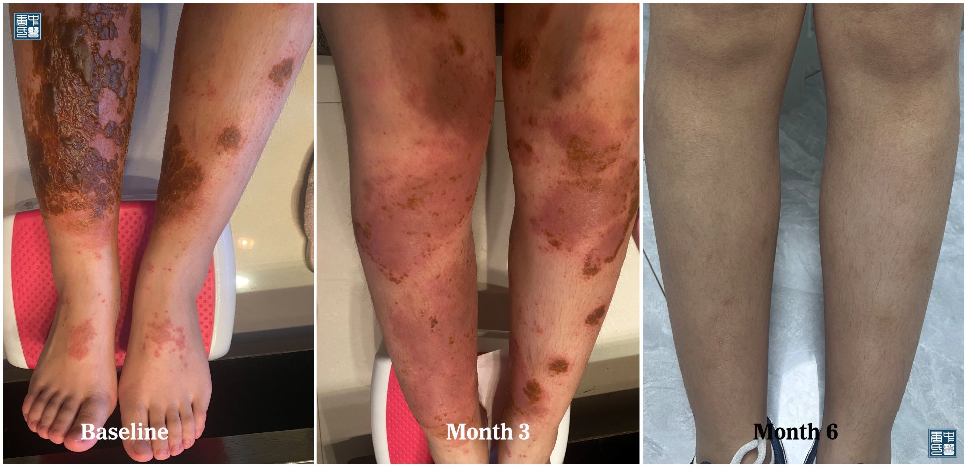 eczema leg 3