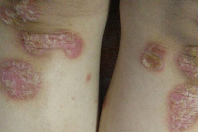 Exacerbation of pre-existing psoriasis following virus infection  病毒感染导致的银屑病加重