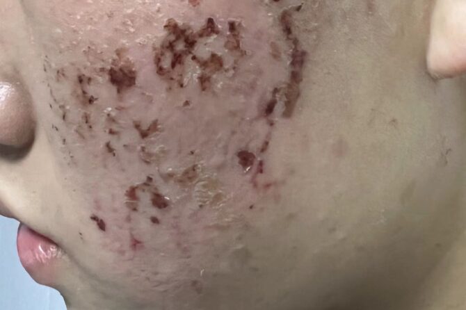 Seborrheic Dermatitis SD 脂溢性皮炎