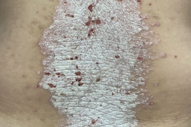 40-year-old with 5-year-Psoriasis Plaque 40岁罹患牛皮癣5年