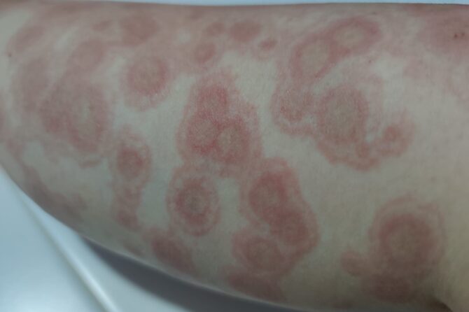 Erythema Multiforme or Urticaria Vasculitis? Different paths lead to the same destination 殊途同归