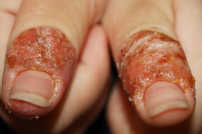 6 years old girl with 3 years of eczema 六岁女孩罹患三年湿疹