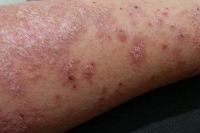 50-year-old with 12-month Pityriasis Lichenoides Chronic PLC 苔藓样糠疹