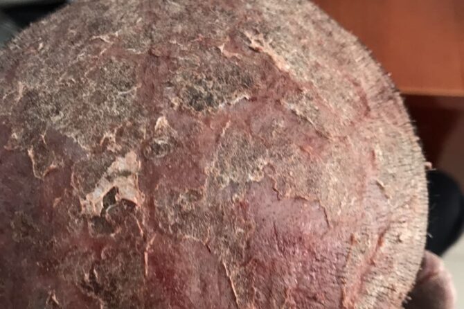 Acute Severe Eczema 急性湿疹发作