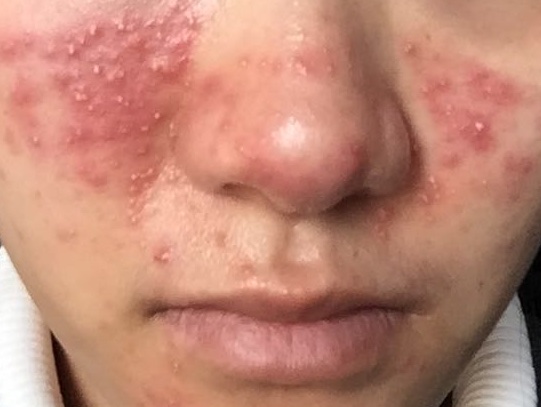 Steroid-Induced Rosacealike Dermatitis (SIRD) 类固醇诱导的酒渣鼻样面部皮炎
