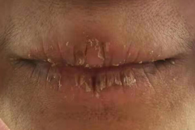 Angular Cheilitis and Eczema-like Hand Lesions in a 35-Year-Old Woman 口角唇炎与湿疹