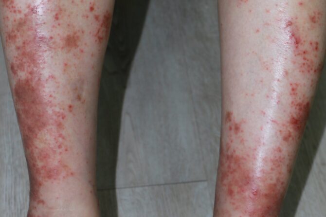A Case of Recalcitrant Acute Eczematous Dermatitis Resolving with Customized Herbal Medicinal Formula 对抗生素和激素治疗无效的急性湿疹一例