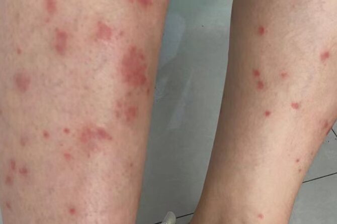 10 years history of psoriasis 10年银屑病