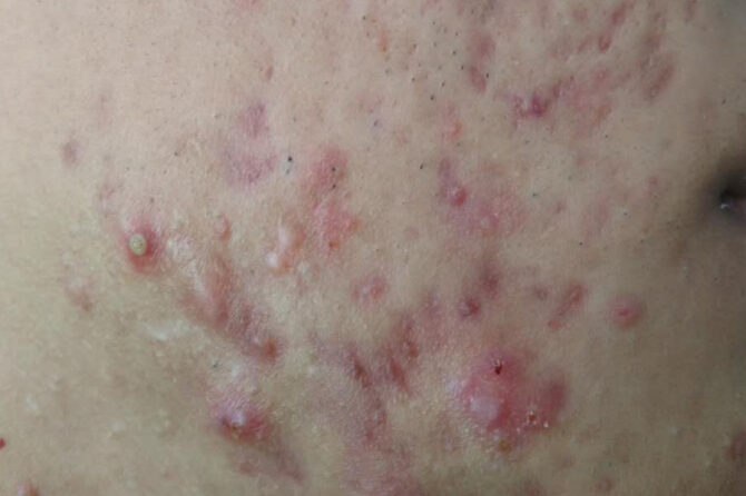 Teen Acne 青少年痤疮痤疮