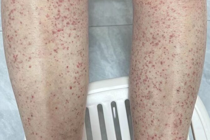 IgA Vasculitis (Henoch-Schönlein purpura) in the Elderly 老年过敏性紫癜一例