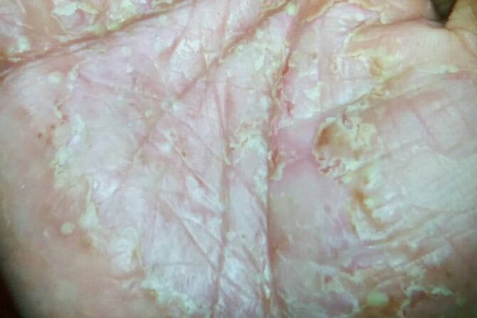 Pompholyx (dyshidrosis) Eczema 汗疱疹