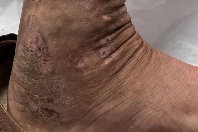 Prurigo Simplex cocombid with Stasis Dermatitis 痒疹并发瘀积型皮炎