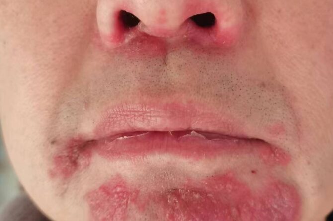 Case report of exacerbation of pre-existing Seborrheic Dermatitis following COVID-19 vaccines 一例先前存在的脂溢性皮炎接种疫苗后病情加重