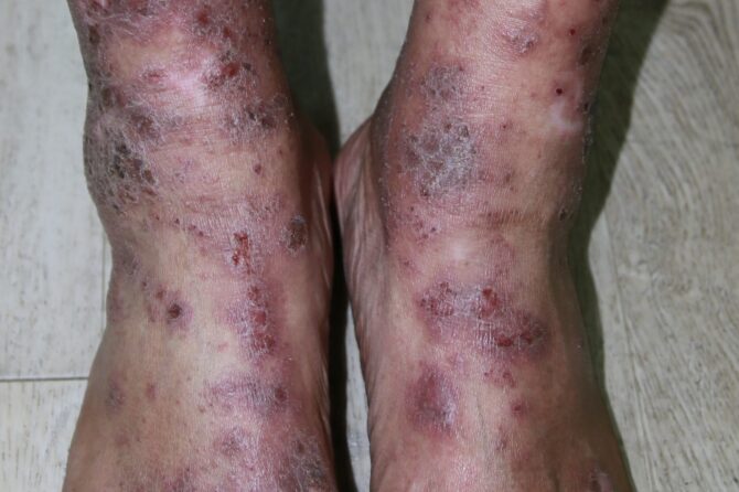 Management of Chronic Eczema with Traditional Chinese Medicine TCM 慢性湿疹的中医治疗