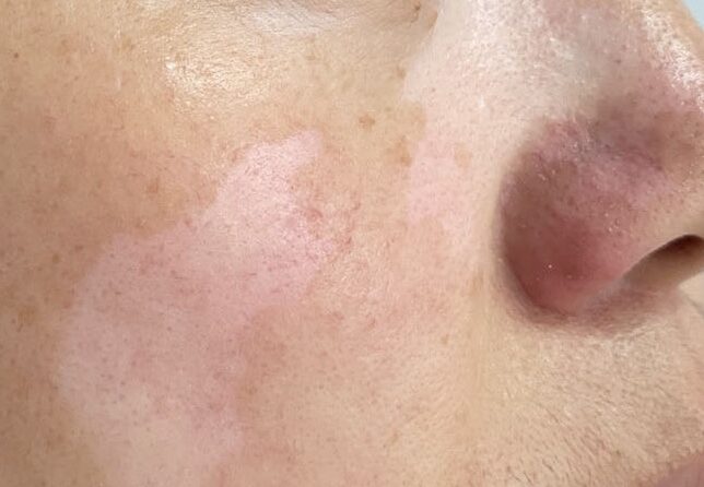 The Primary Traditional Chinese Medicine Treatment for Vitiligo 白癜风的中药疗法