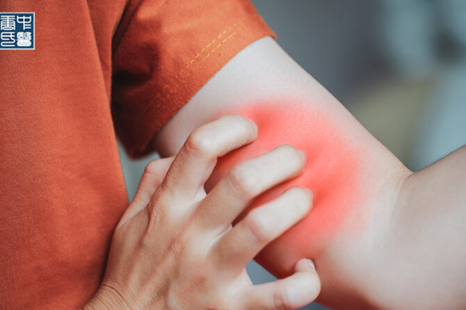 TCM for Eczema: Can TCM Really Help With Eczema?