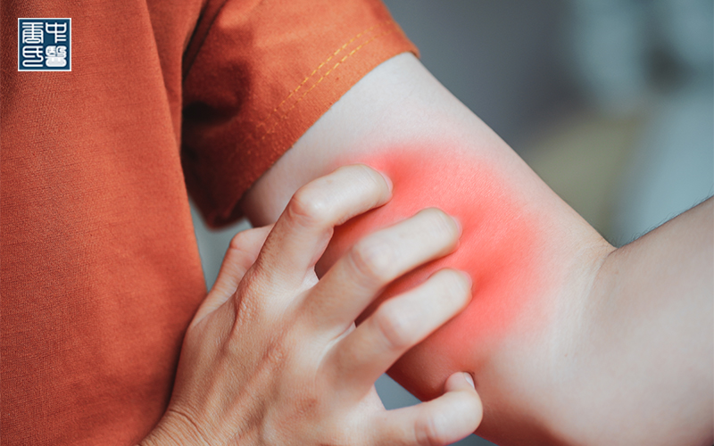 TCM for Eczema: Can TCM Really Help With Eczema?