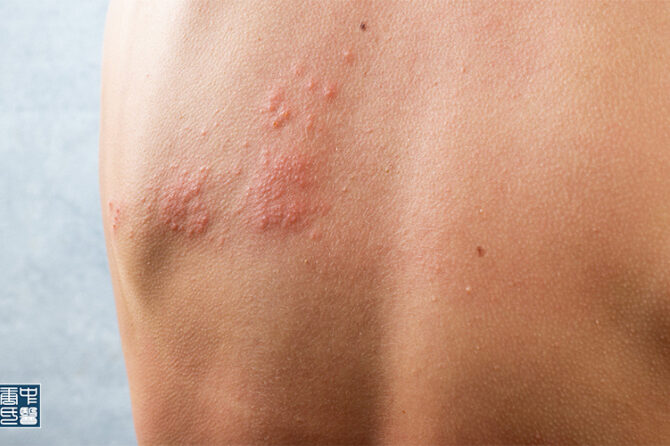 Managing Allergies and Preventing Hives with TCM