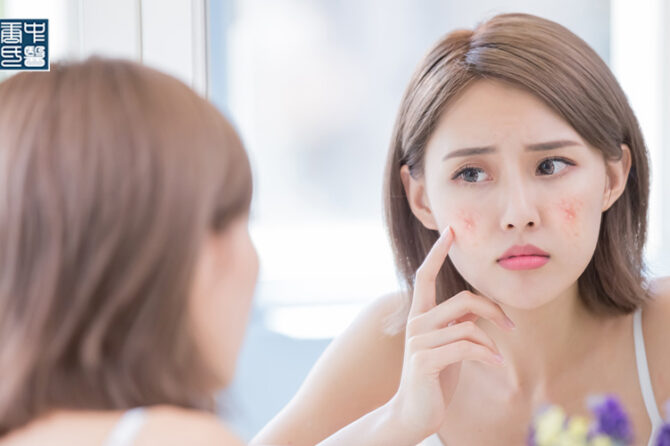Achieving Acne-Free Skin Through TCM: Does it Work?