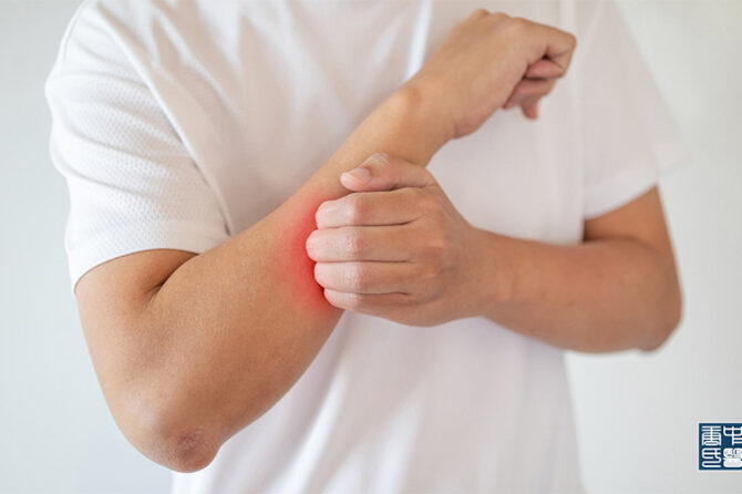 Understanding and Managing Eczema From a TCM Perspective