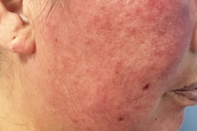 A Natural Journey to Remission: Confronting Acute Cutaneous Lupus Erythematosus 皮肤型红斑性狼疮