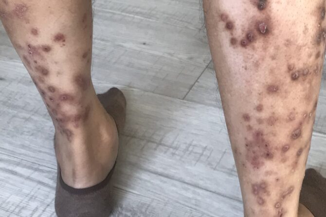 Management of Prurigo Nodularis with Traditional Herbal Medicine 结节性痒疹的中药治疗