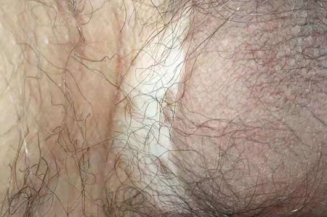 Understanding Vitiligo: TCM’s Approach to Penile Discoloration 外生殖器白斑(白癜风)