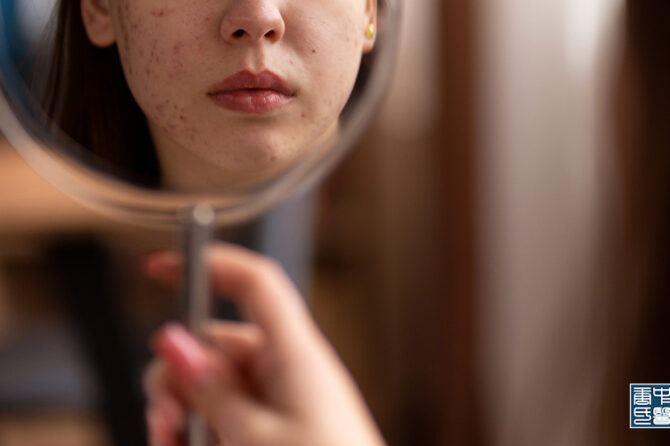What Your Acne Breakout Says About Your Health