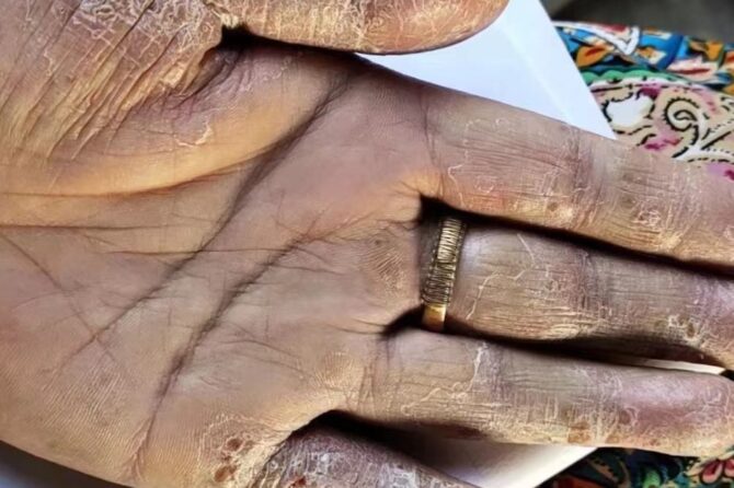 Understanding Palmoplantar Pustulosis: A Pustular Skin Condition Linked to Psoriasis 掌跖脓疱病PPP:一种与牛皮癣有关的皮肤脓疱病
