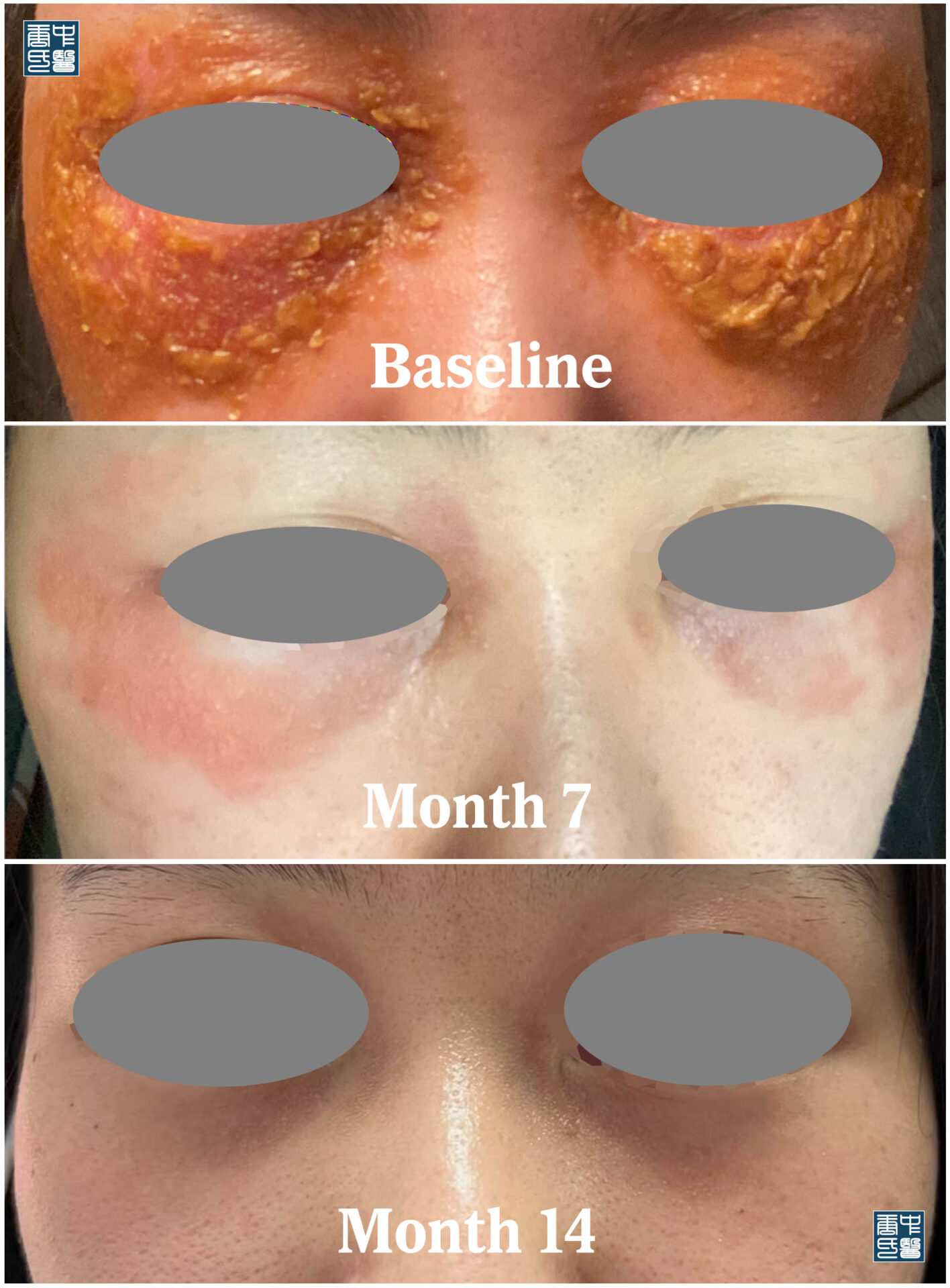 eczema eye A3