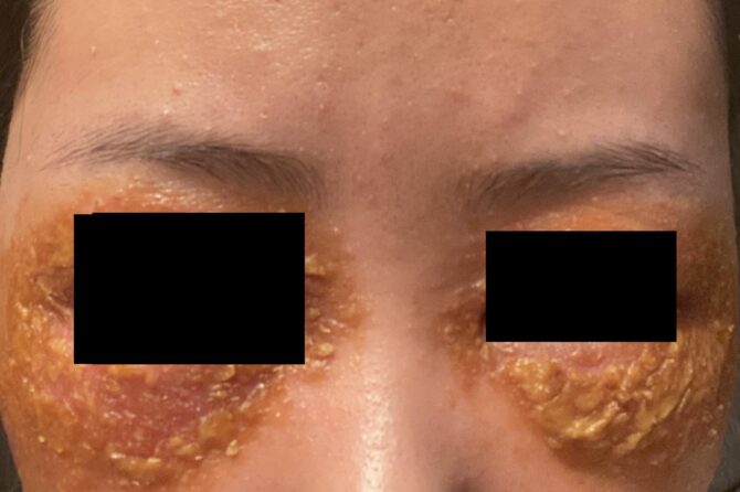 Eczema Transformation: A 14-Month Journey to Clear Skin 急性湿疹