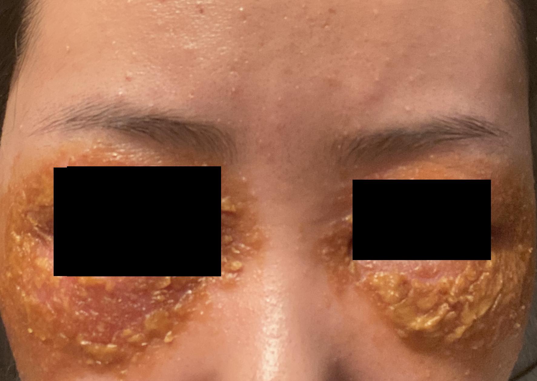 Eczema Transformation: A 14-Month Journey to Clear Skin 急性湿疹