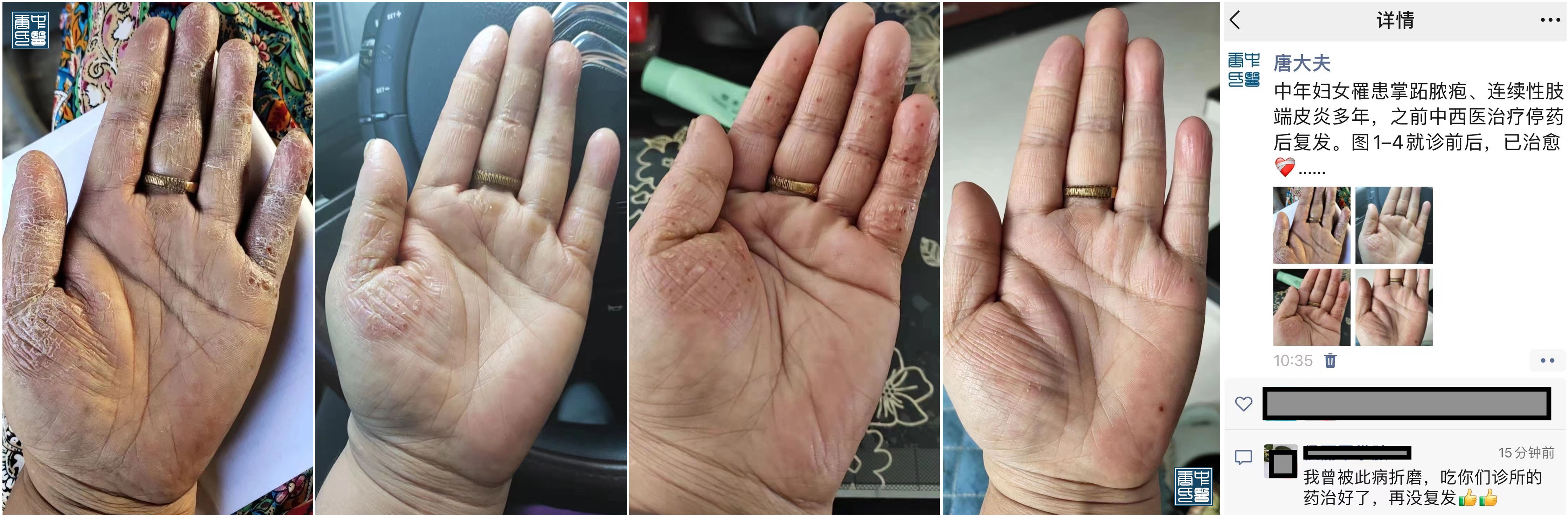 palmoplantar pustulosis 3.jpg