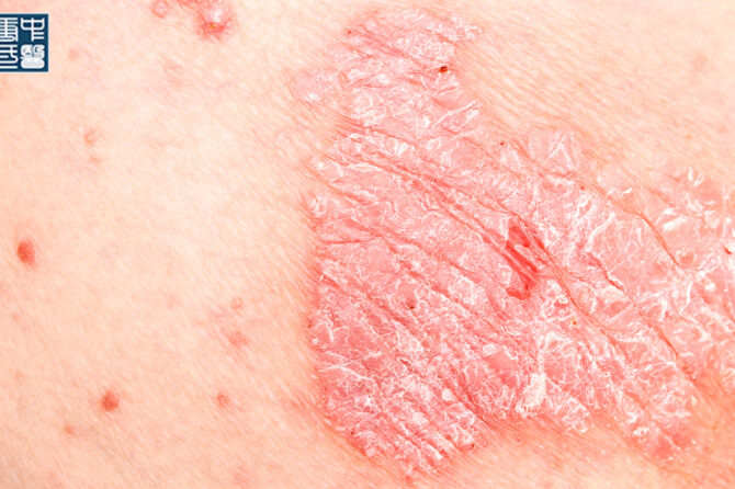 TCM Treatment Options for Psoriasis