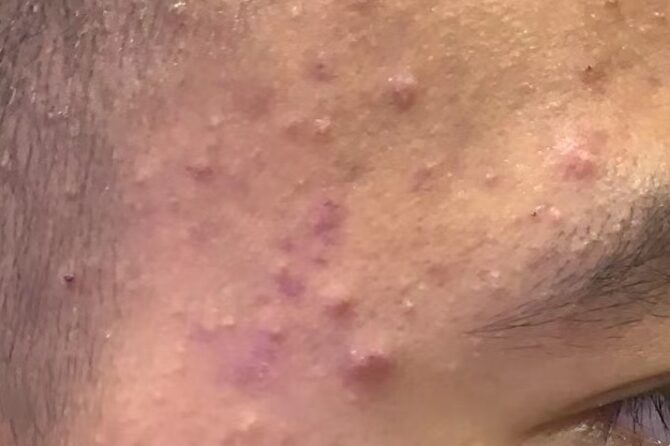 A Journey Against Acne: A Case Report on Herbal Healing 青春痘（痤疮）
