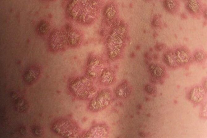 Herbal Treatment for Pediatric Psoriasis: A Case Report 儿童银屑病