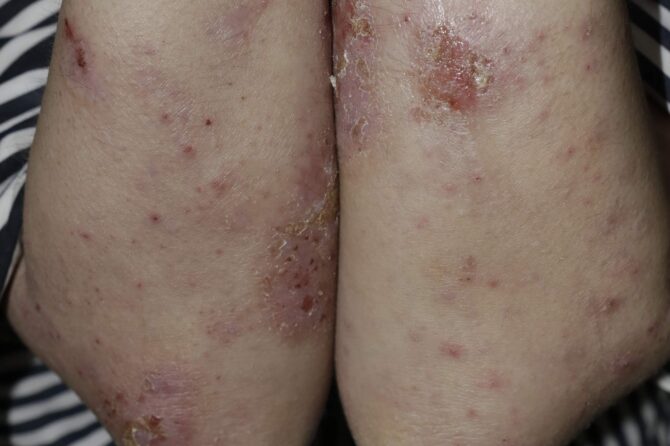 Management of Vaccine-Induced Eczema Flare-Up with Herbal Traditional Chinese Medicine: A Case Report 疫苗激发的湿疹治疗