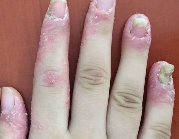A Journey to Healing: Overcoming Palmoplantar Pustular Psoriasis (PPP) 掌跖脓疱病