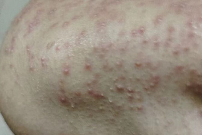 Understanding the Causes of Skin Folliculitis 毛囊炎
