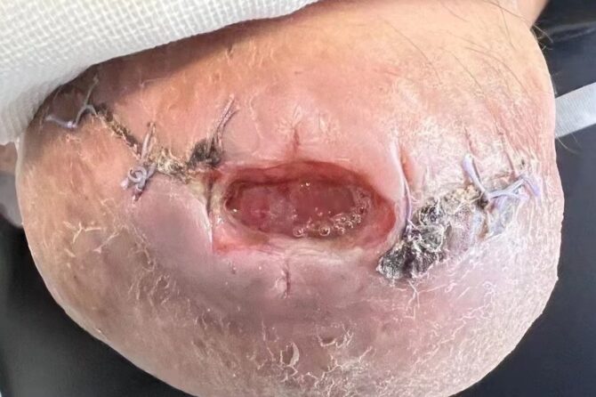 Healing of Chronic Surgical Wound with Topical Herbal HLQ Ointment