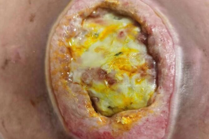 Stage-4 Pressure Ulcers 褥疮